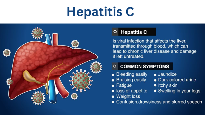Hepatitis C: Understanding the Virus, Its Impact, and Emerging Treatment Approaches